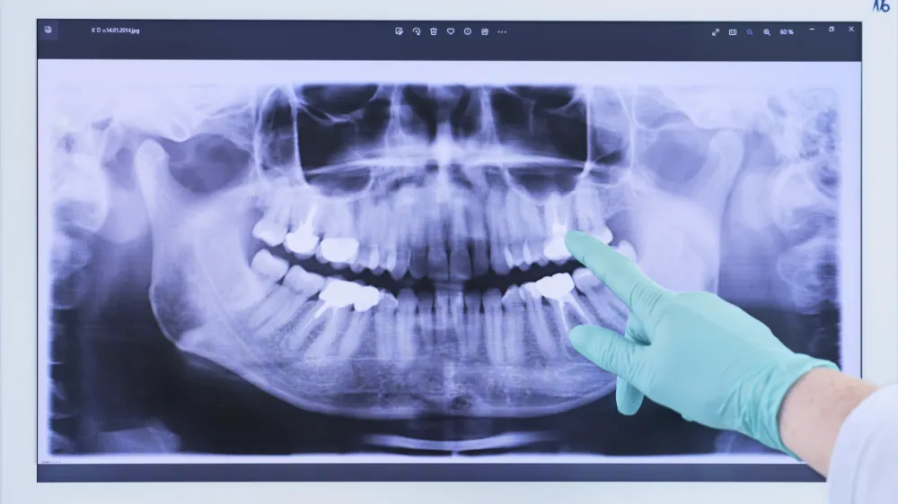 Röntgenaufnahme eines Gebisses, auf der ein Finger in Handschuhen einen bestimmten Zahn zeigt.